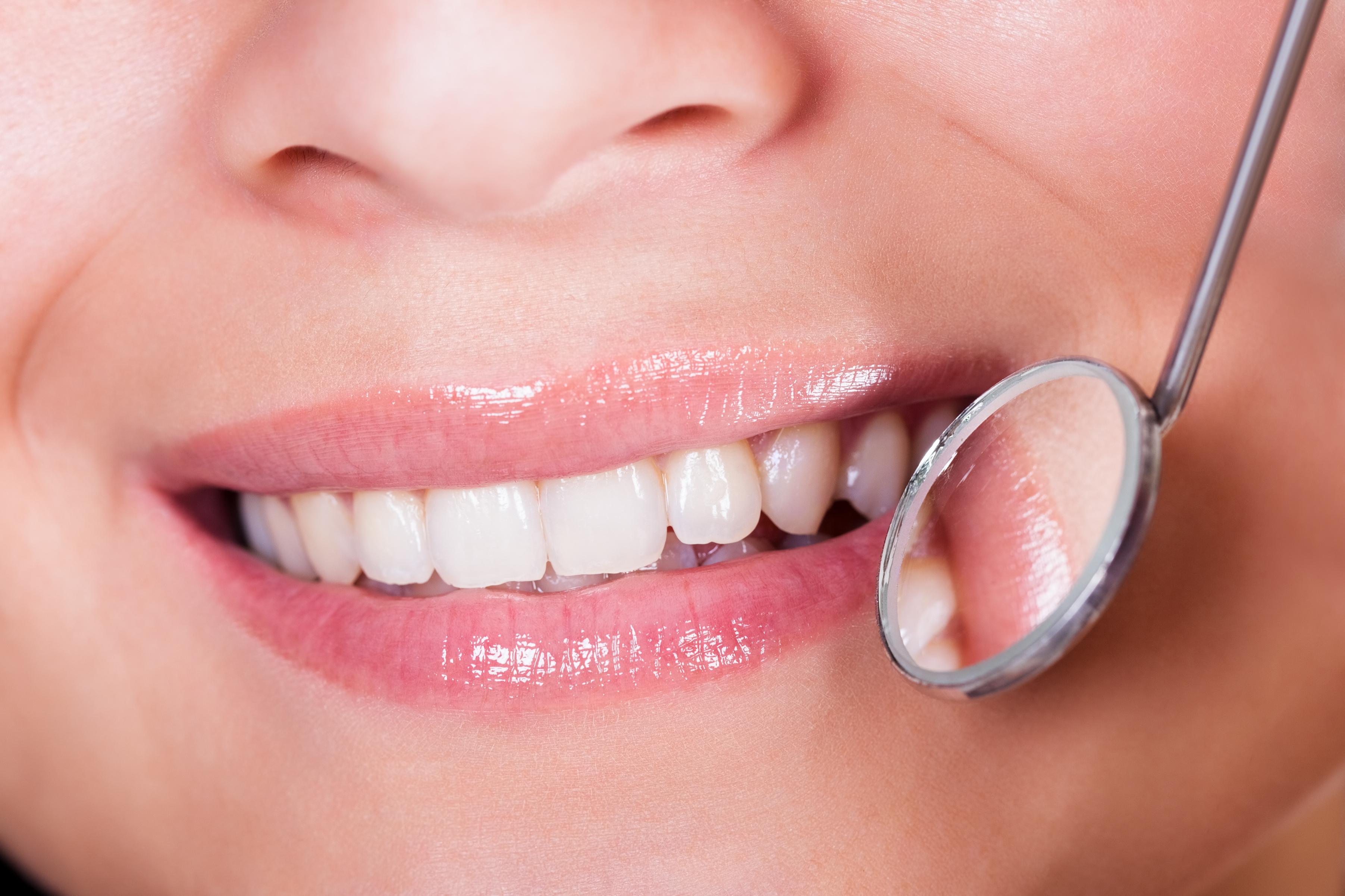 teeth colored fillings pikesville