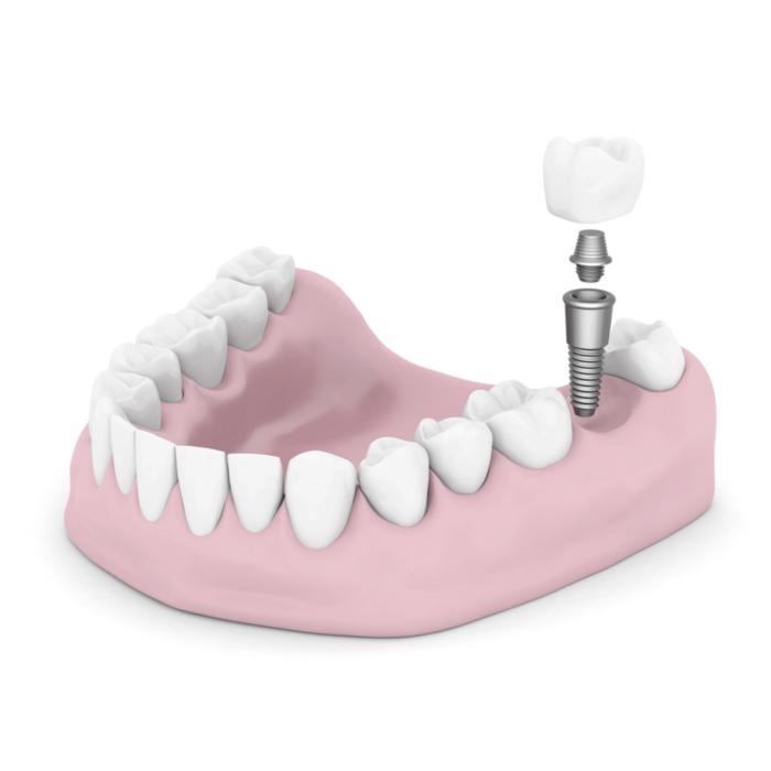 dental implants pikesville md