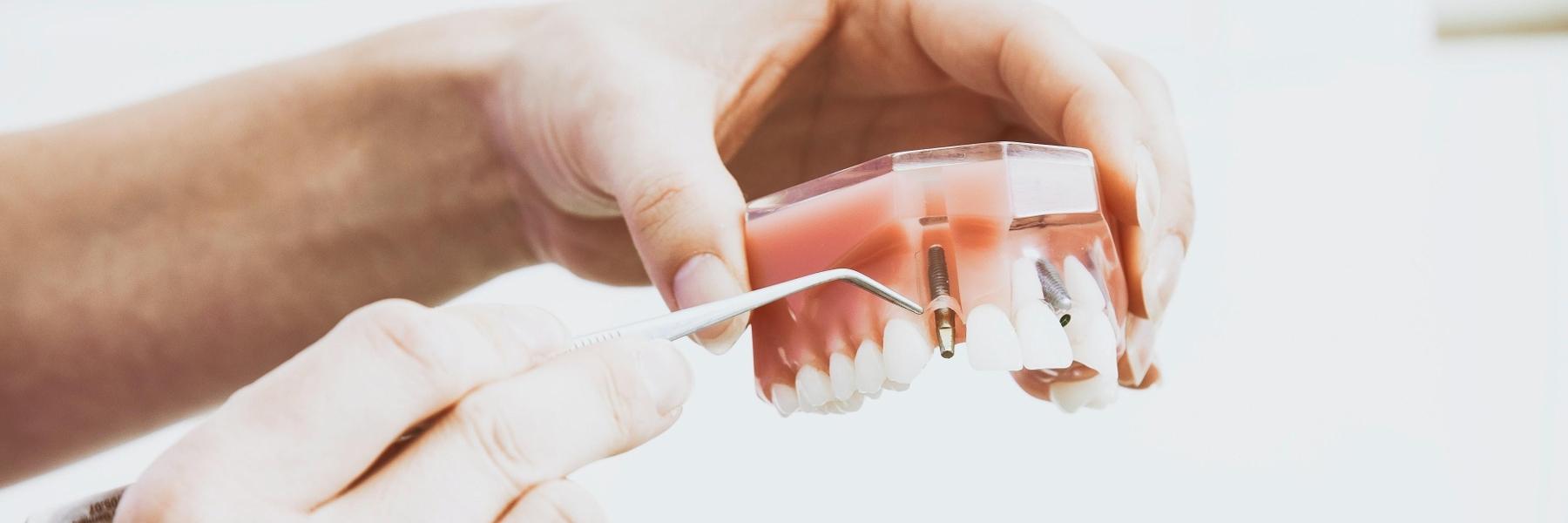 Hand holding a dental crown and implant in Pikesville, MD