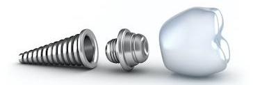 Illustration of a dental implant in Pikesville, MD