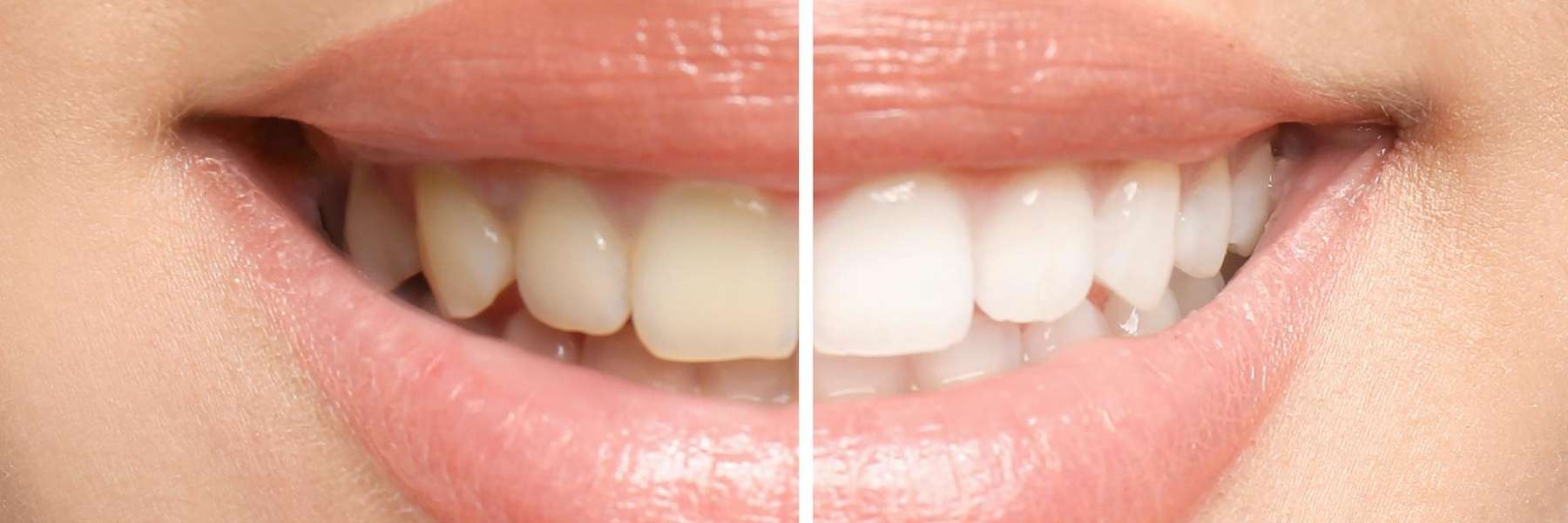 a side by side photo collage of before and after Teeth Whitening in Pikesville, MD