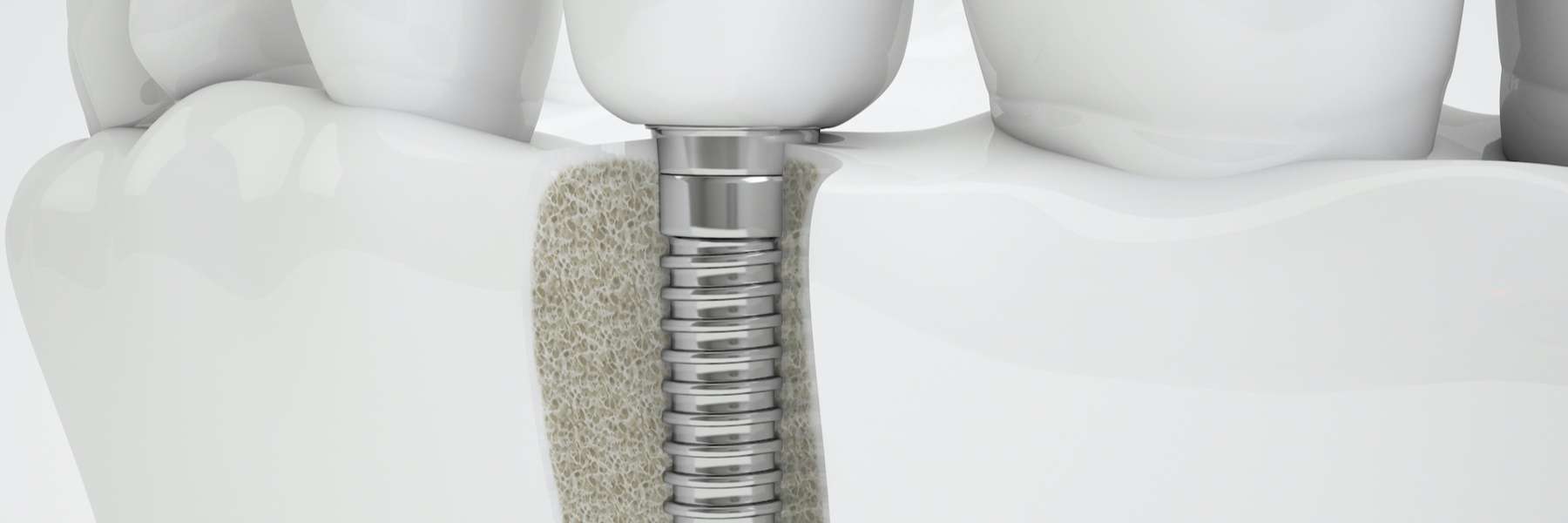 An illustration of Dental Implants in Pikesville, MD