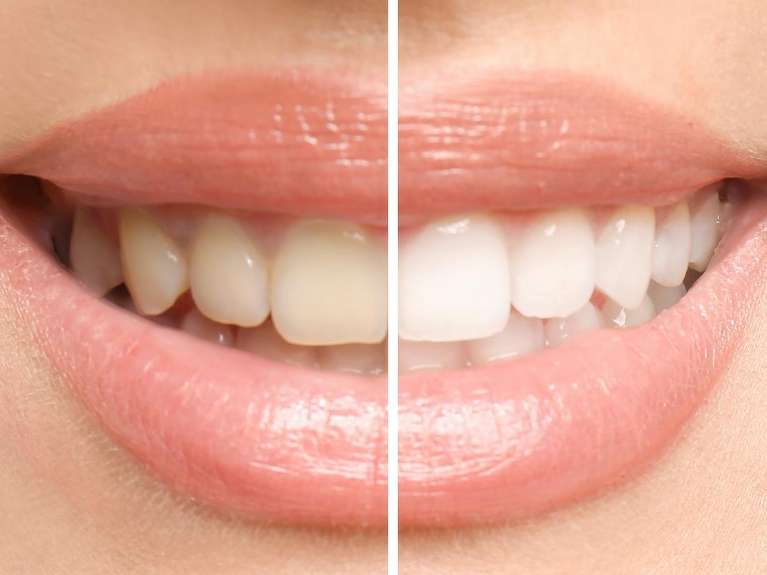 Zoom! In-Office Whitening in Pikesville, MD