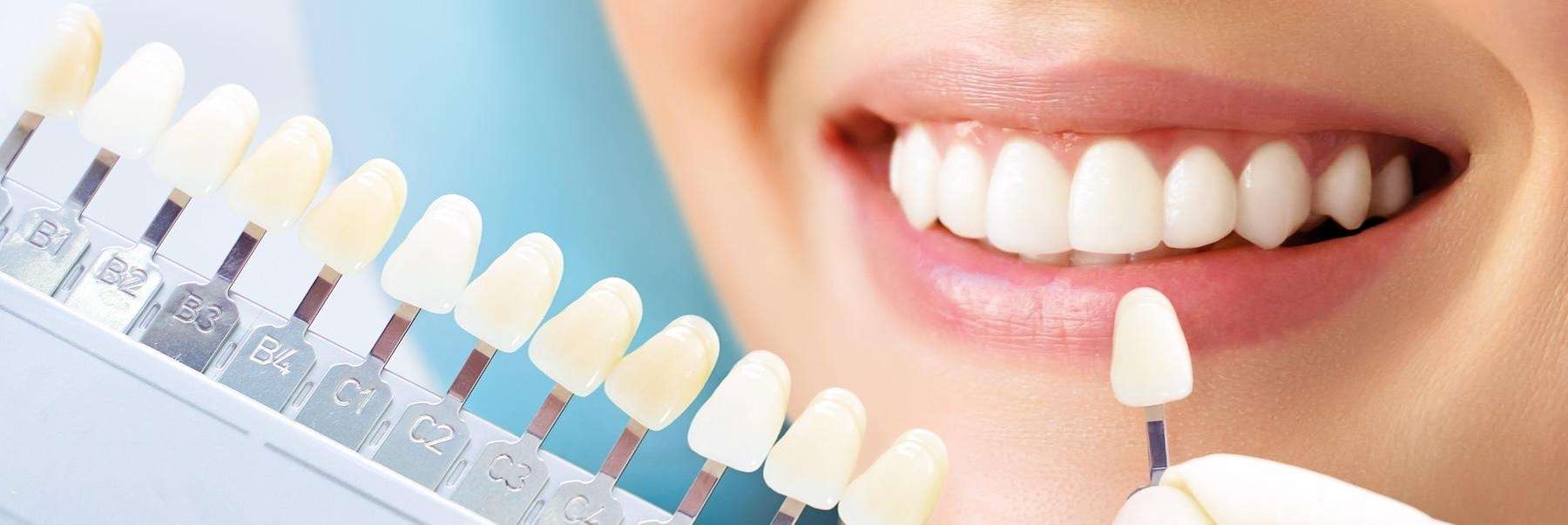 Teeth whitening shade guide in Pikesville, MD