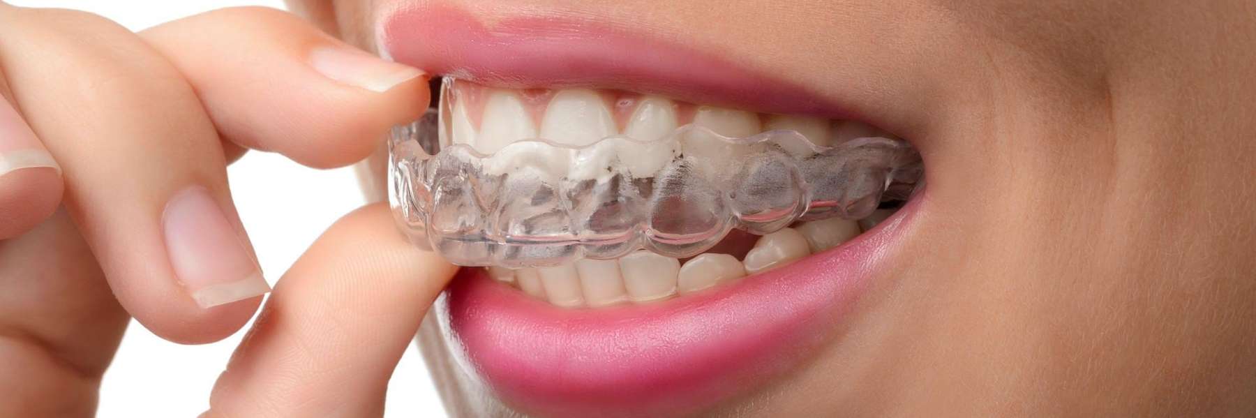 A patient trying out Affordable Invisalign in Pikesville, MD