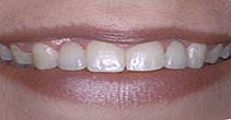 same teeth after dental implants | Pikesville MD