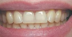 Image of teeth before Zoom! Whitening | Pikesville MD