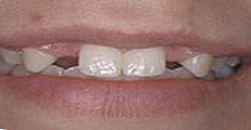 teeth before dental implants | Pikesville MD
