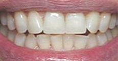 Image of the same teeth after Zoom! Whitening | Pikesville MD