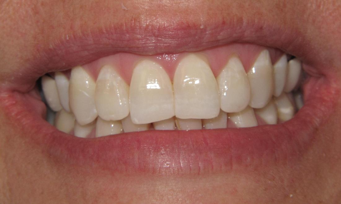 crooked teeth before Invisalign | Pikesville MD