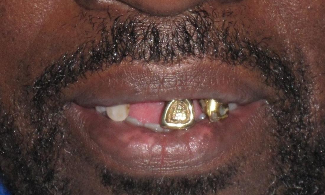 image of teeth before a temporary partial denture | Pikesville MD