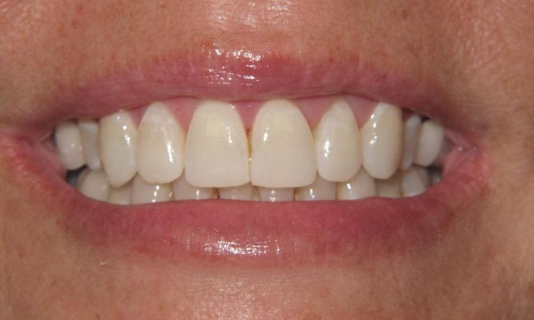 Invisalign-After-Image