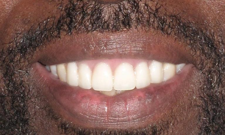 Partial-Dentures-After-Image