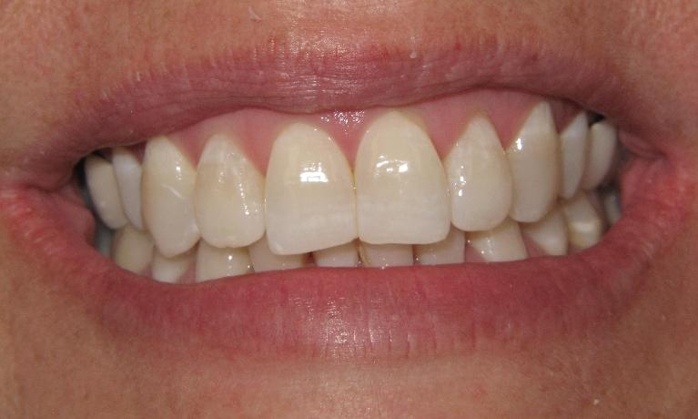 Invisalign-Before-Image